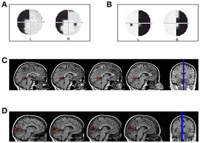 Lights from the Dark: Neural Responses from a Blind Visual Hemifield